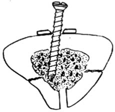 �ǿ��۶�ʽ�ɹǾ��̶���